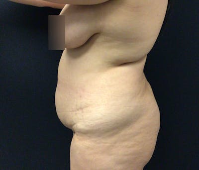 Liposuction Before & After Gallery - Patient 91440443 - Image 9