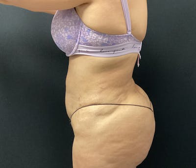 Liposuction Before & After Gallery - Patient 91440443 - Image 10