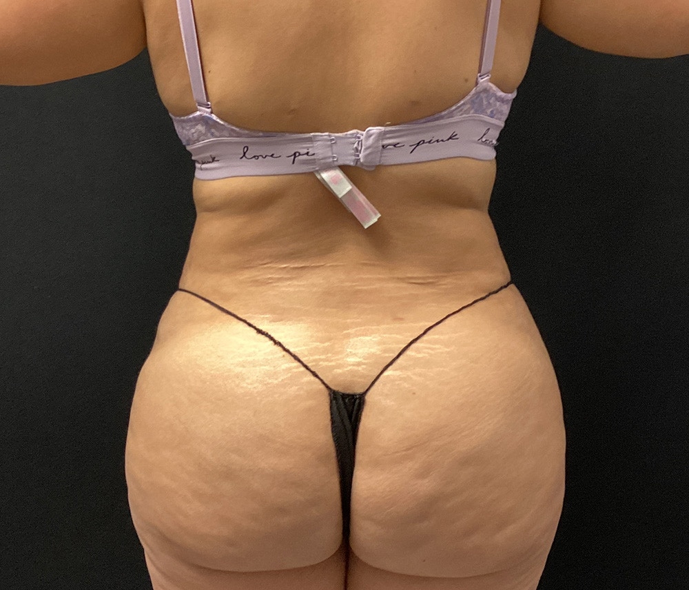 Liposuction Before & After Gallery - Patient 91440443 - Image 12