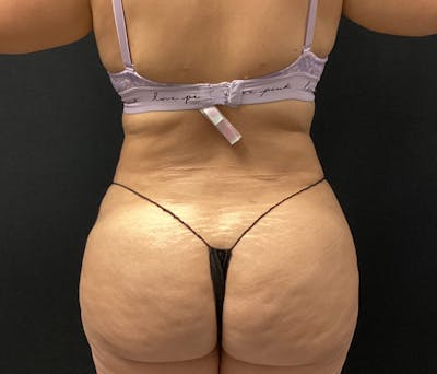 Liposuction Before & After Gallery - Patient 91440443 - Image 12