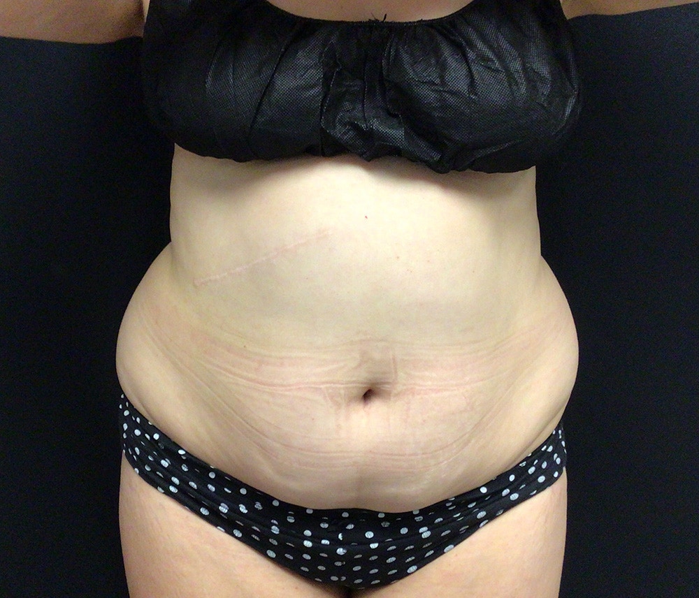 Liposuction Before & After Gallery - Patient 91440501 - Image 1