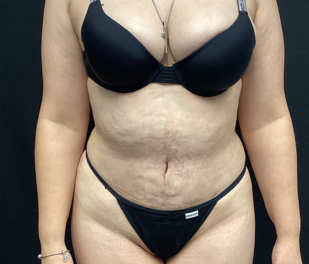 Lipo 360 Before & After Gallery - Patient 91440501 - Image 2