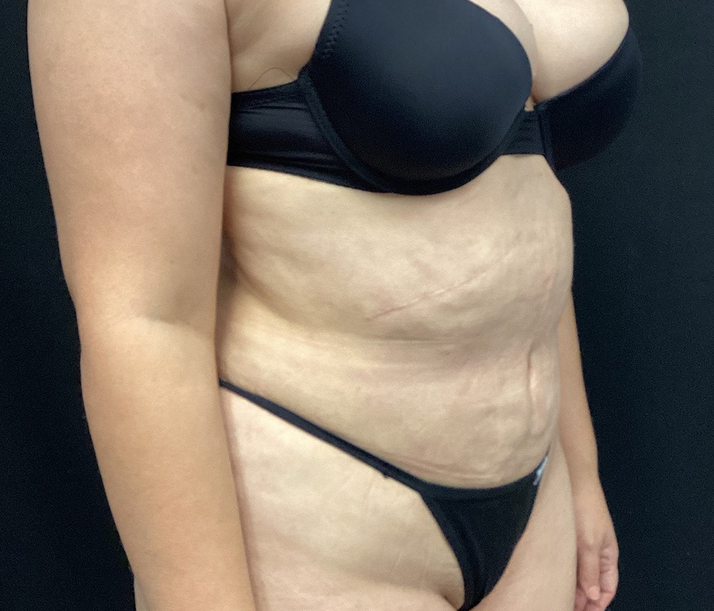 Liposuction Before & After Gallery - Patient 91440501 - Image 4