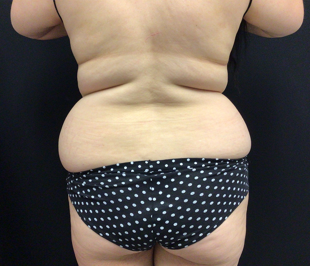 Liposuction Before & After Gallery - Patient 91440501 - Image 5