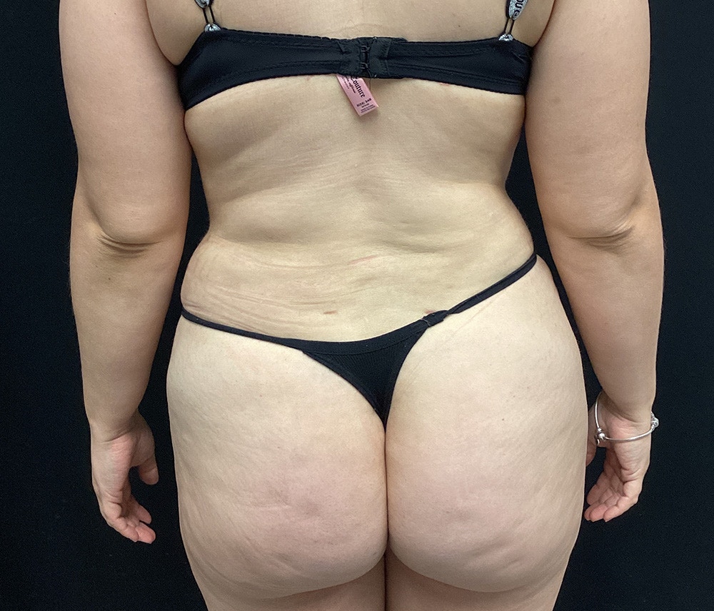 Lipo 360 Before & After Gallery - Patient 91440501 - Image 6