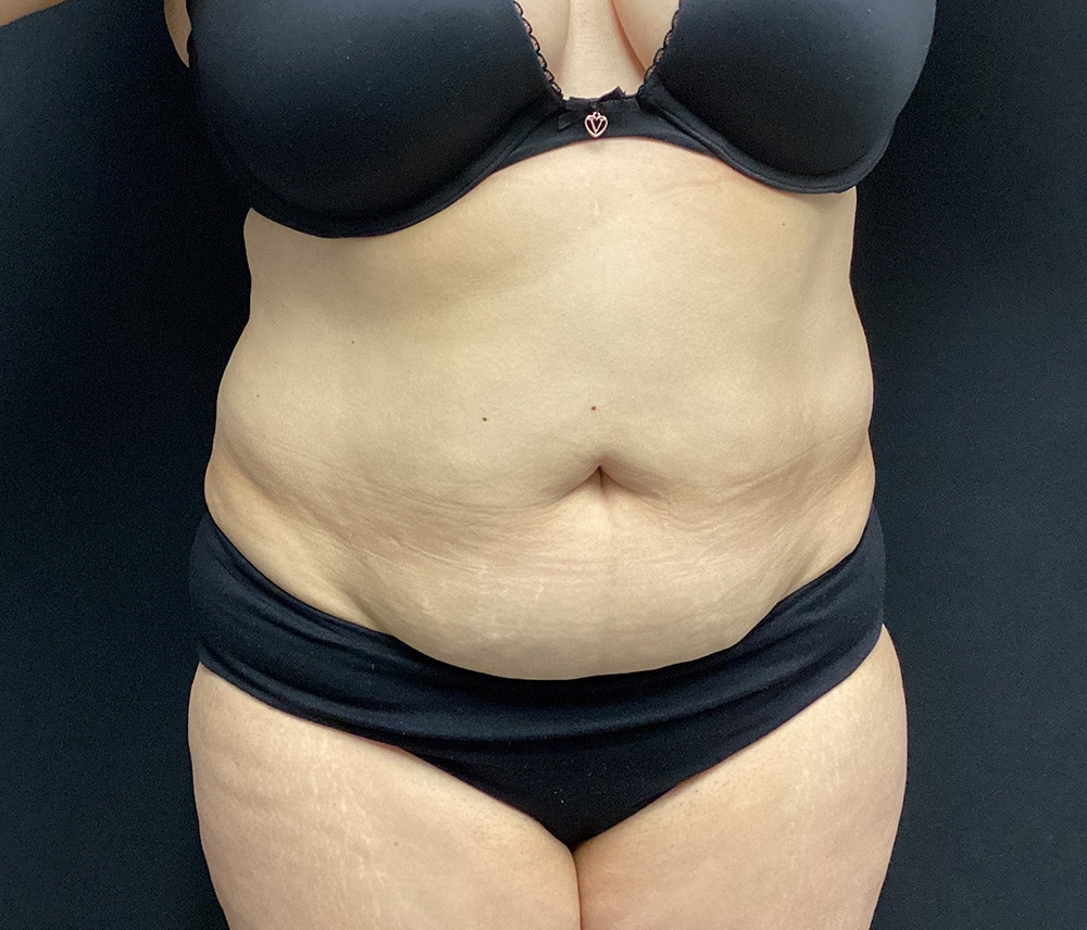 Liposuction Before & After Gallery - Patient 91440512 - Image 1