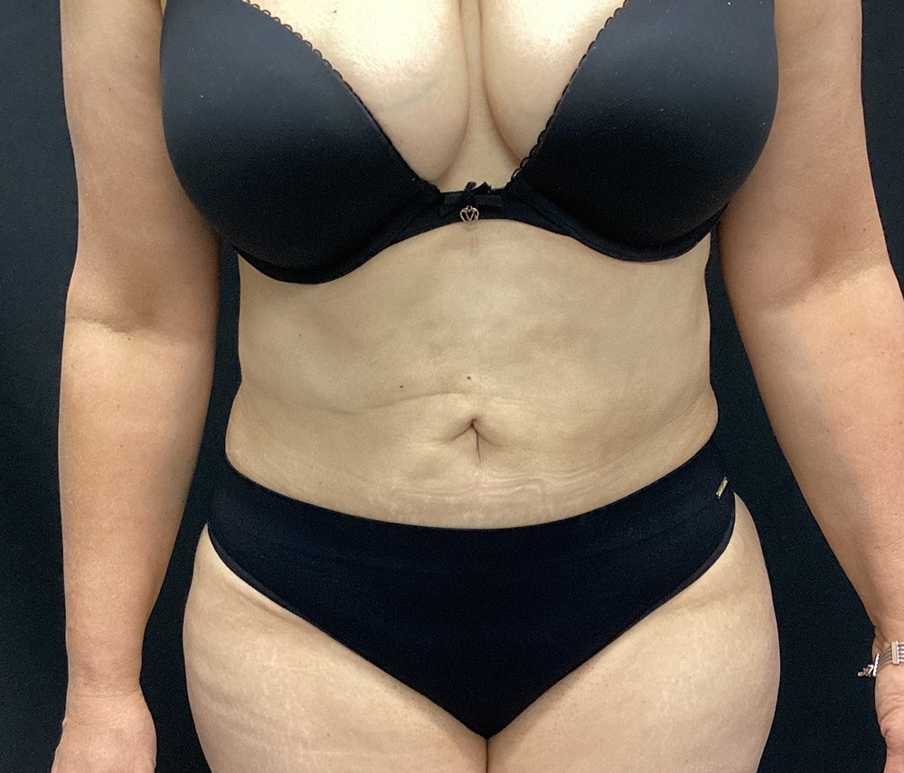 Lipo 360 Before & After Gallery - Patient 91440512 - Image 2