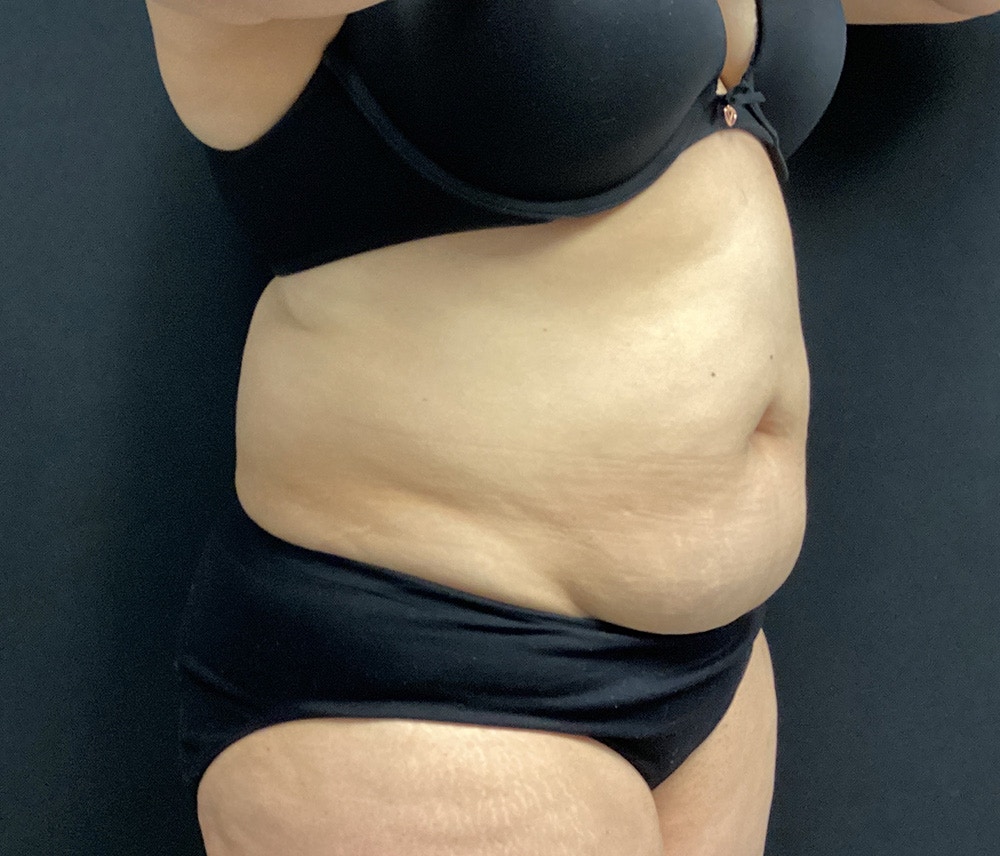 Lipo 360 Before & After Gallery - Patient 91440512 - Image 3