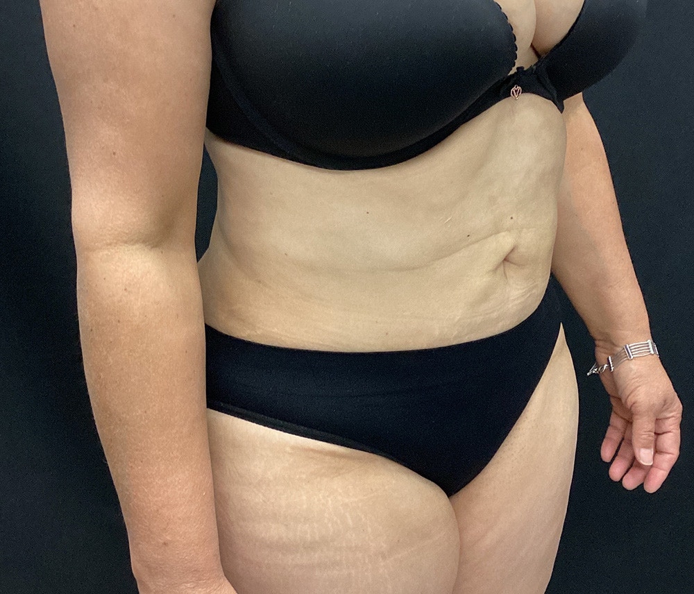Liposuction Before & After Gallery - Patient 91440512 - Image 4