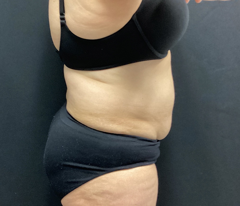 Lipo 360 Before & After Gallery - Patient 91440512 - Image 5