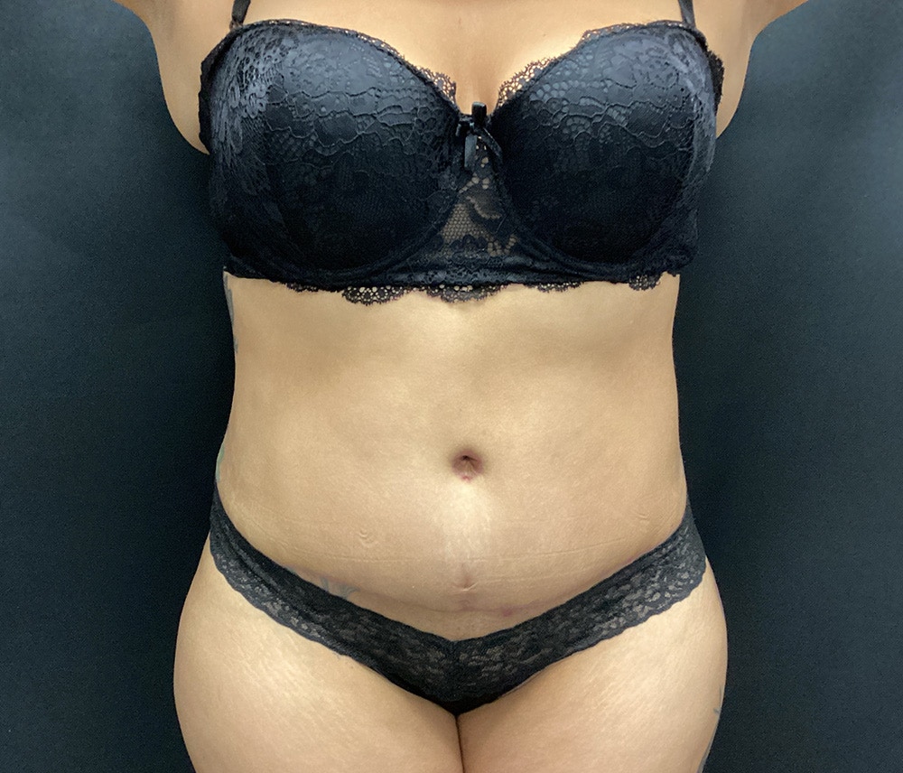 Lipo 360 Before & After Gallery - Patient 74784377 - Image 2