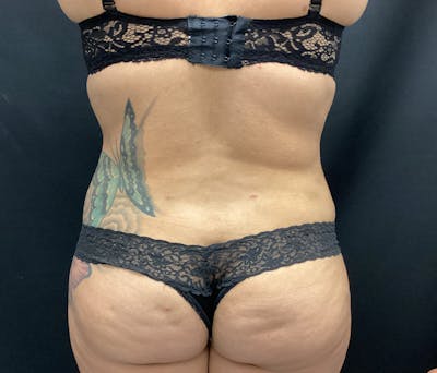 Liposuction Before & After Gallery - Patient 74784377 - Image 8
