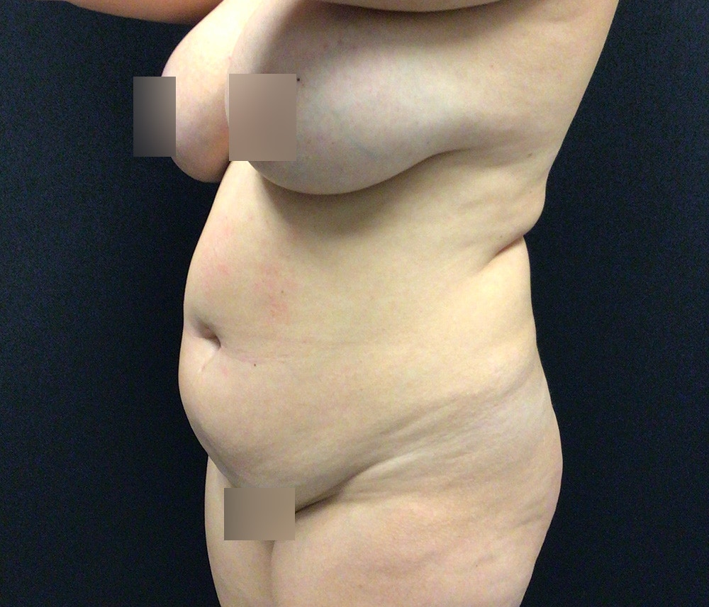 Liposuction Before & After Gallery - Patient 72237404 - Image 9