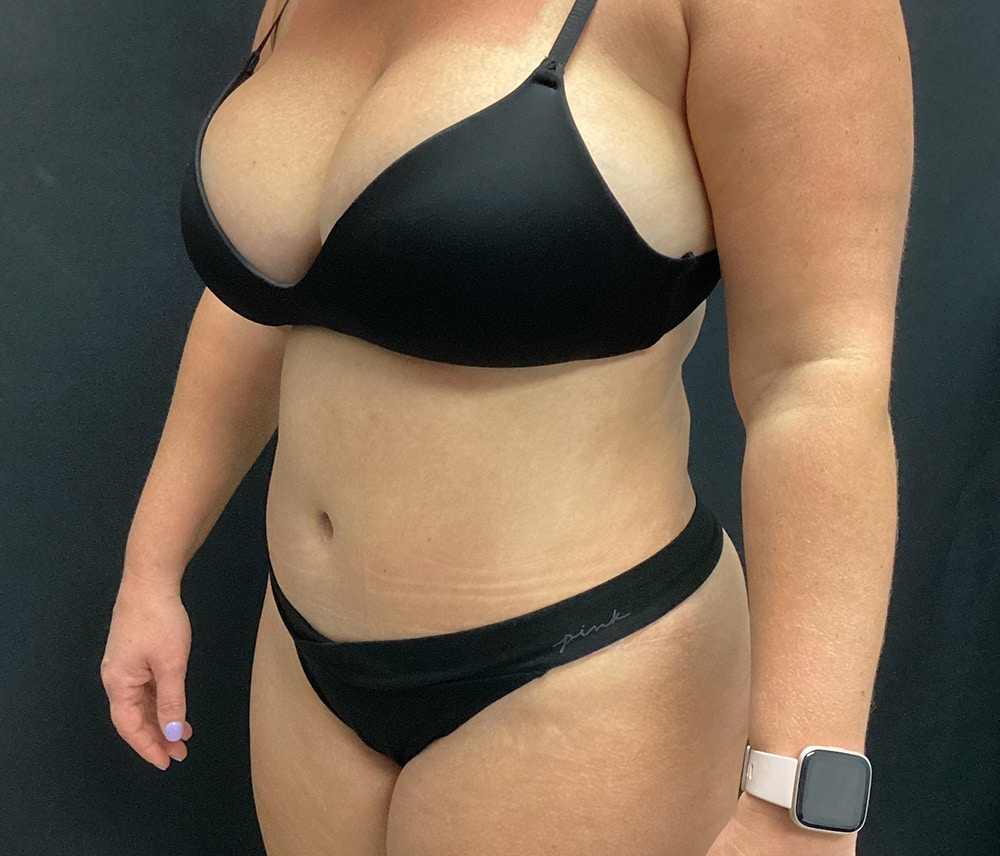 Lipo 360 Before & After Gallery - Patient 72237404 - Image 10