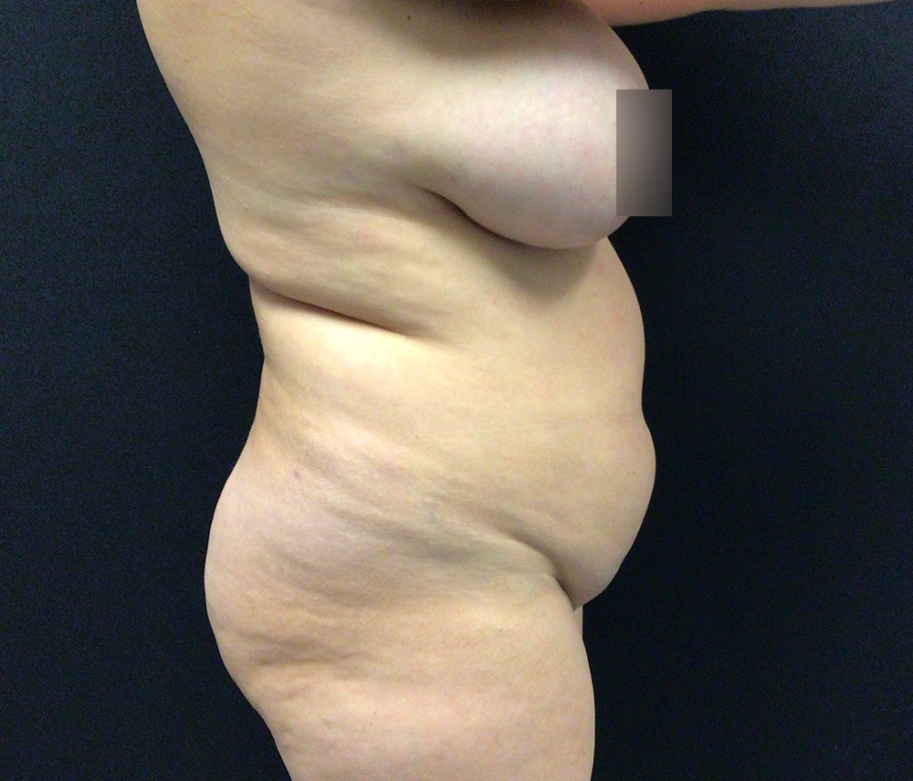 Lipo 360 Before & After Gallery - Patient 72237404 - Image 11