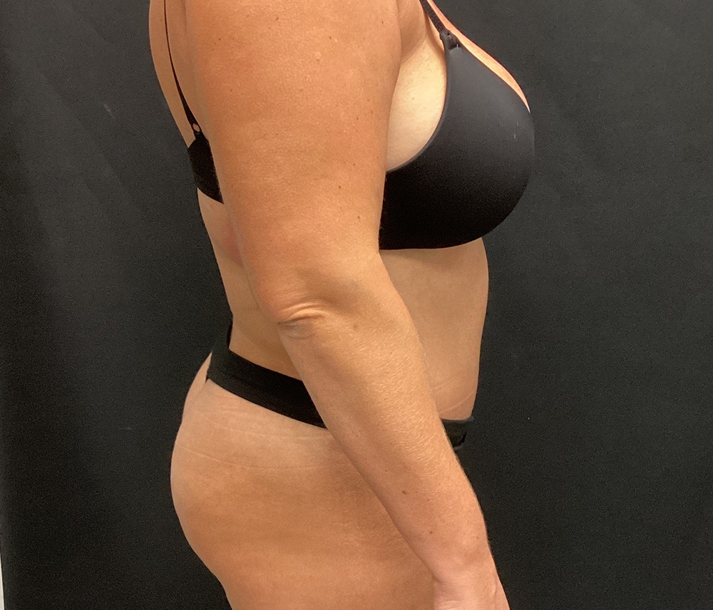 Lipo 360 Before & After Gallery - Patient 72237404 - Image 12