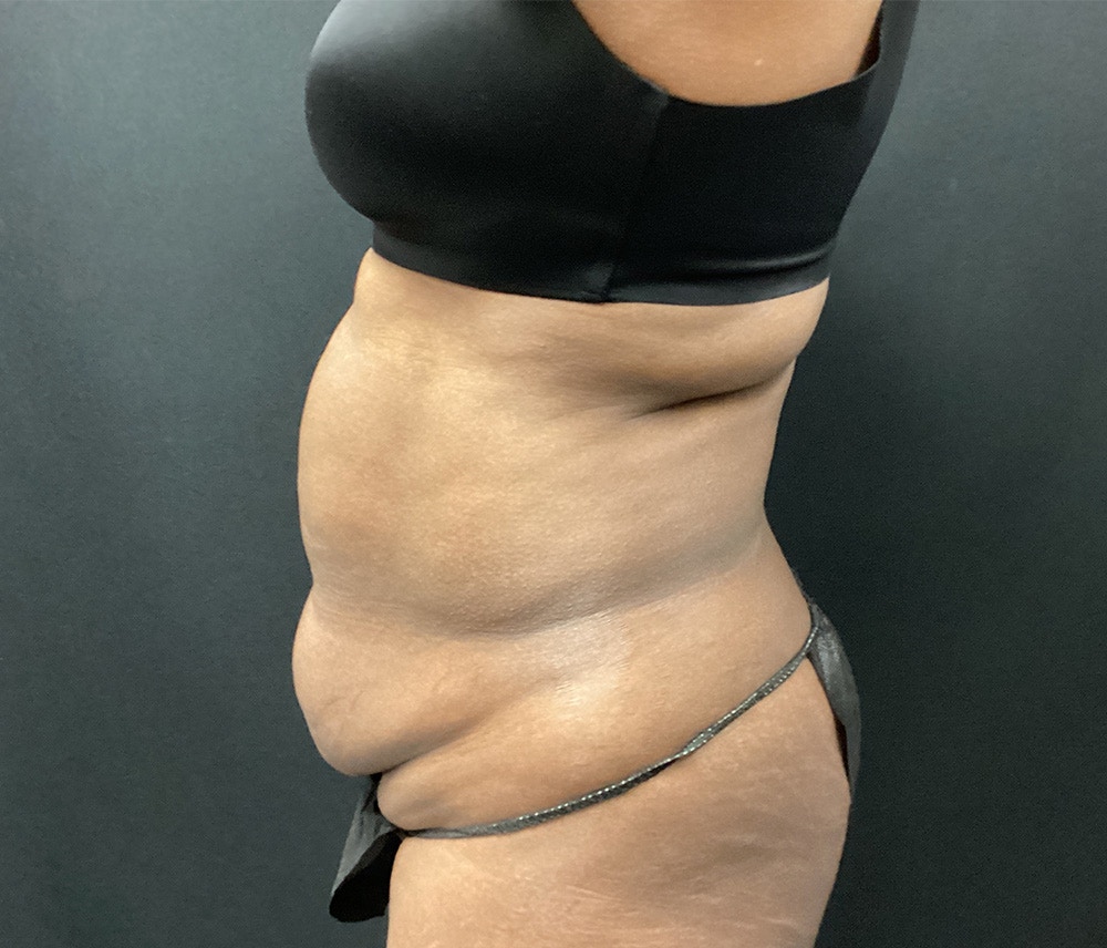 Liposuction Before & After Gallery - Patient 89193832 - Image 5