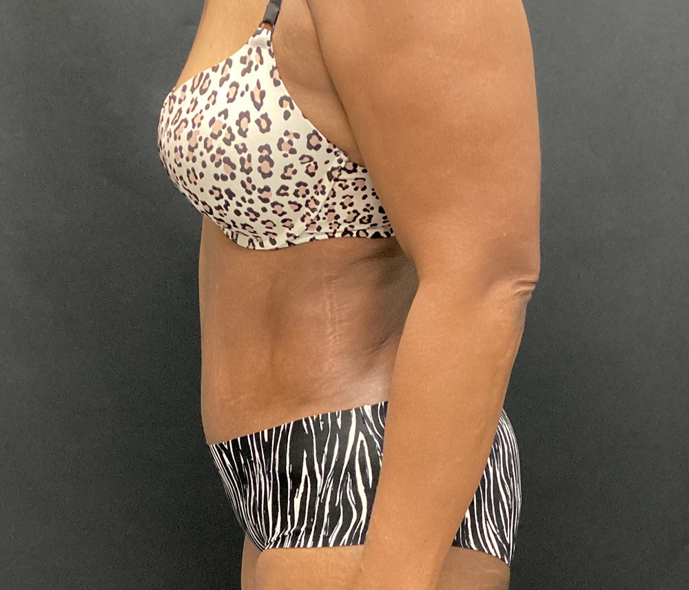 Liposuction Before & After Gallery - Patient 89193832 - Image 6
