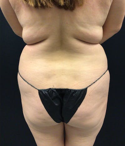 Brazilian Butt Lift Before & After Gallery - Patient 102616892 - Image 1