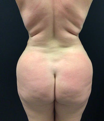 Brazilian Butt Lift Before & After Gallery - Patient 102616892 - Image 2