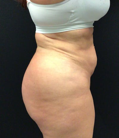 Brazilian Butt Lift Before & After Gallery - Patient 102616892 - Image 4