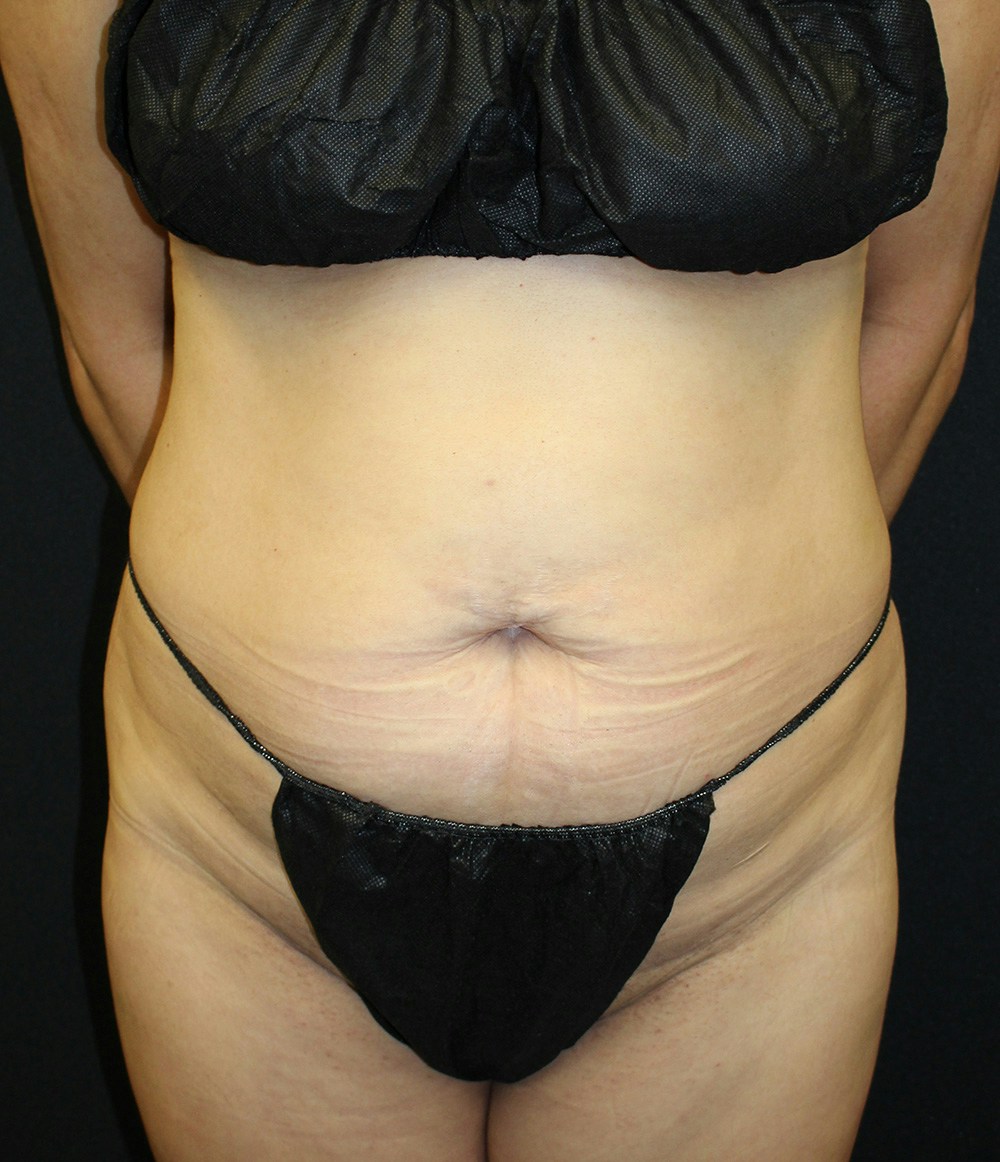 Brazilian Butt Lift Before & After Gallery - Patient 102617009 - Image 3