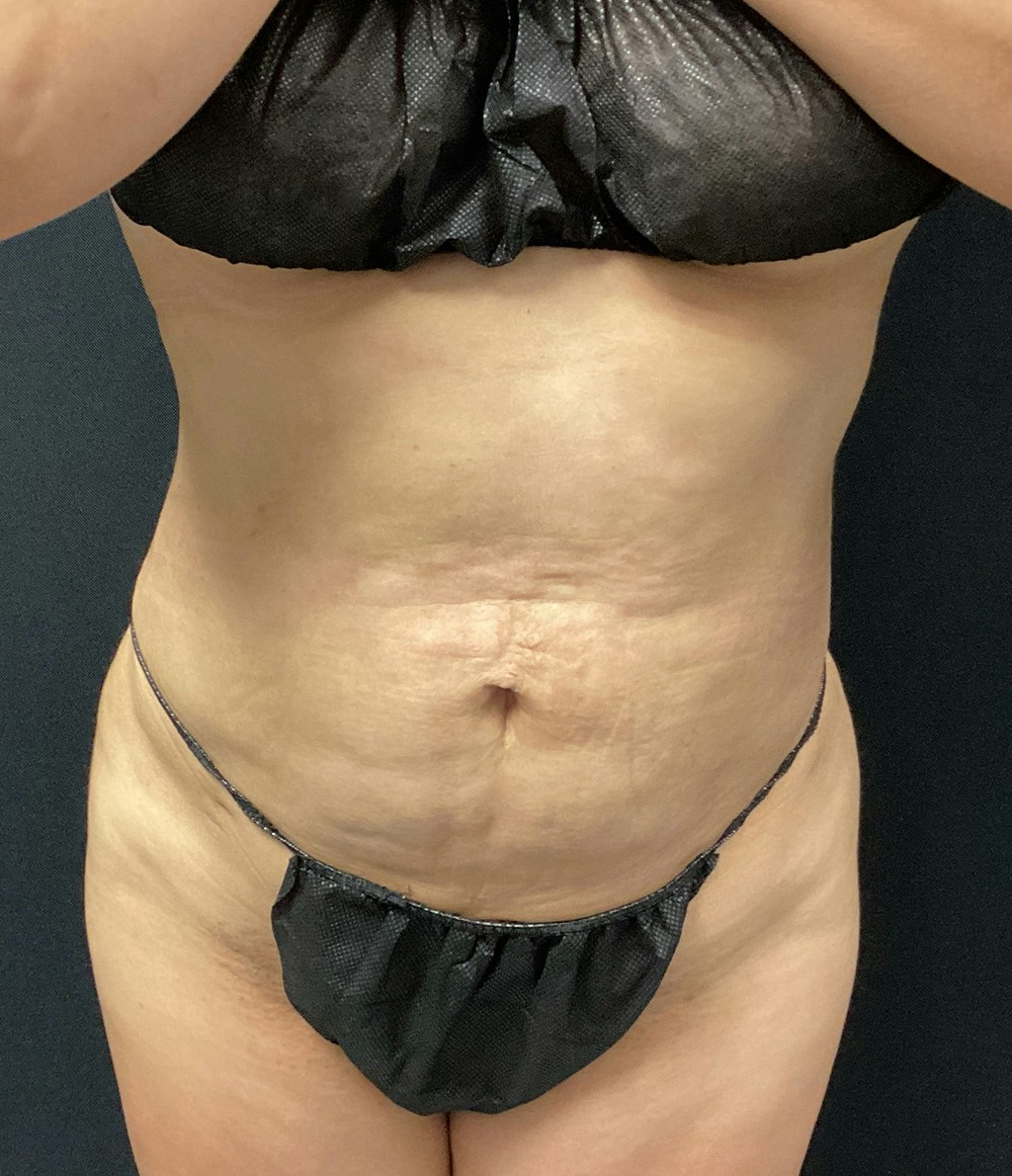 Brazilian Butt Lift Before & After Gallery - Patient 102617009 - Image 4