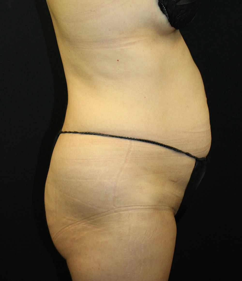 Brazilian Butt Lift Before & After Gallery - Patient 102617009 - Image 5