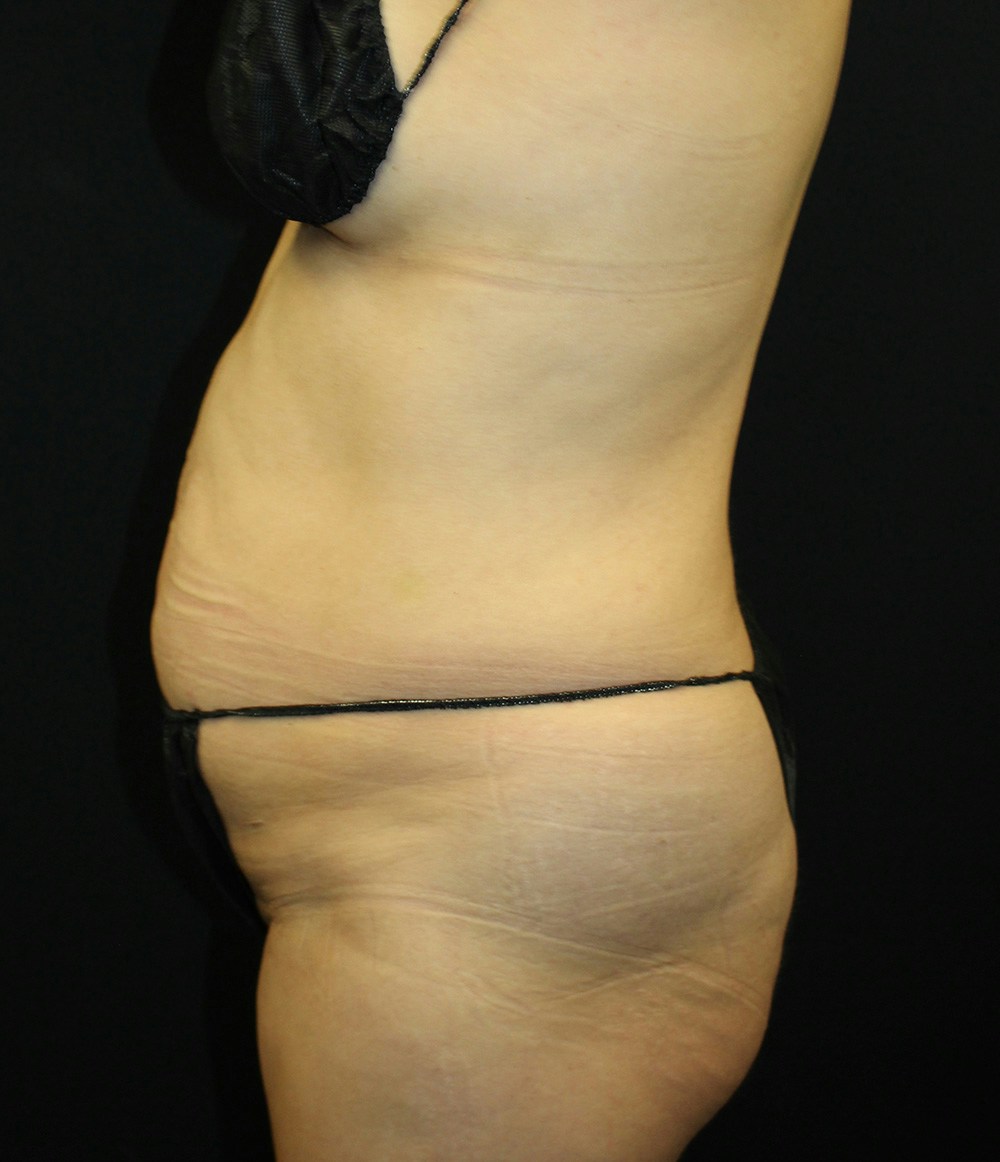 Brazilian Butt Lift Before & After Gallery - Patient 102617009 - Image 7