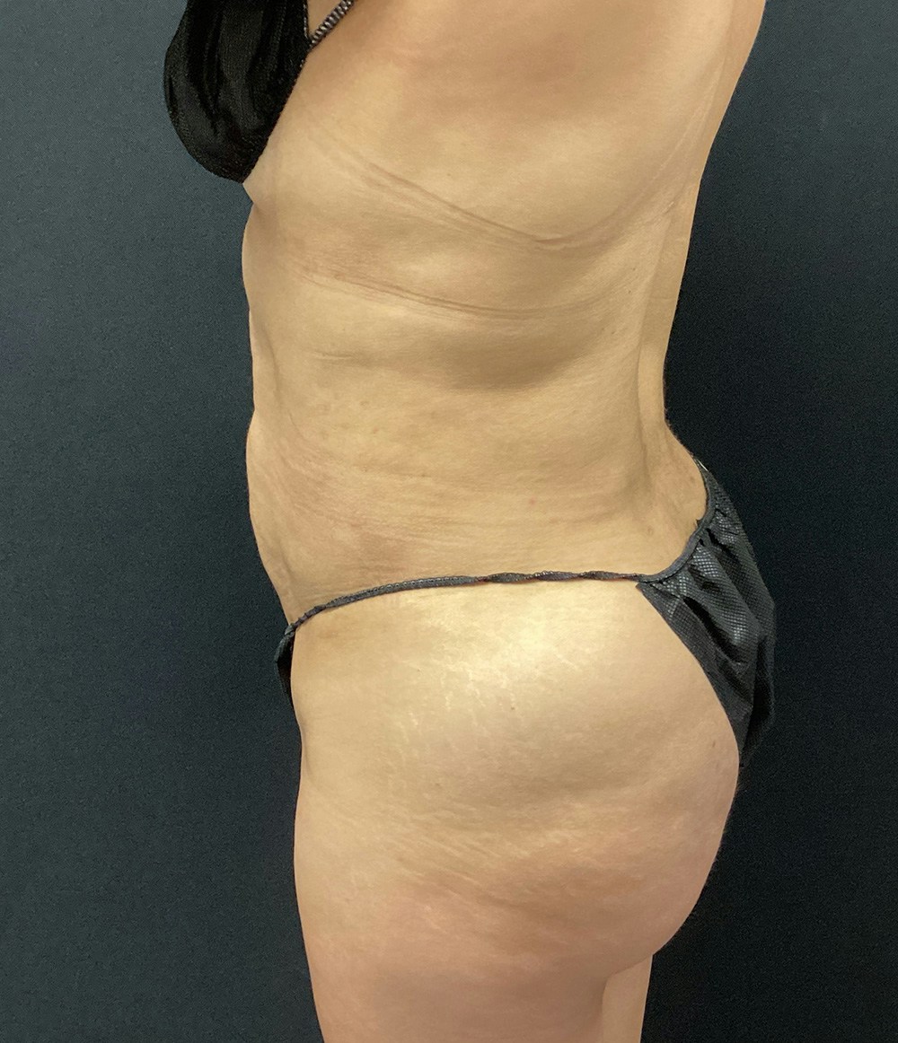 Brazilian Butt Lift Before & After Gallery - Patient 102617009 - Image 8
