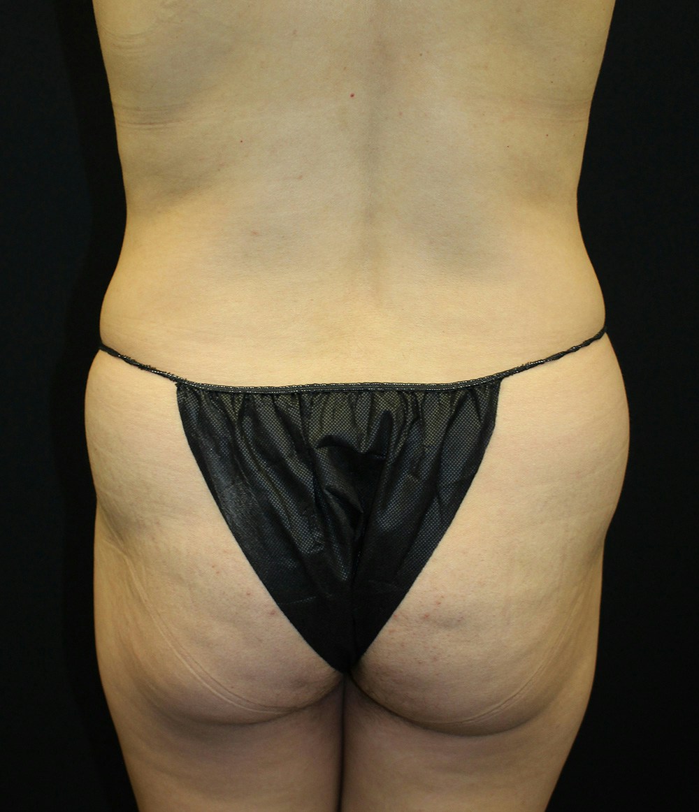 Brazilian Butt Lift Before & After Gallery - Patient 102617009 - Image 1