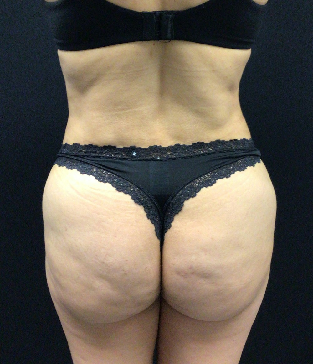 Brazilian Butt Lift Before & After Gallery - Patient 102617009 - Image 2