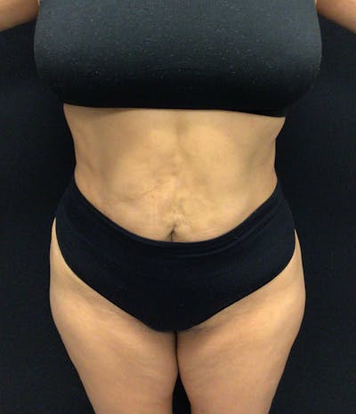 Brazilian Butt Lift Before & After Gallery - Patient 102617008 - Image 4