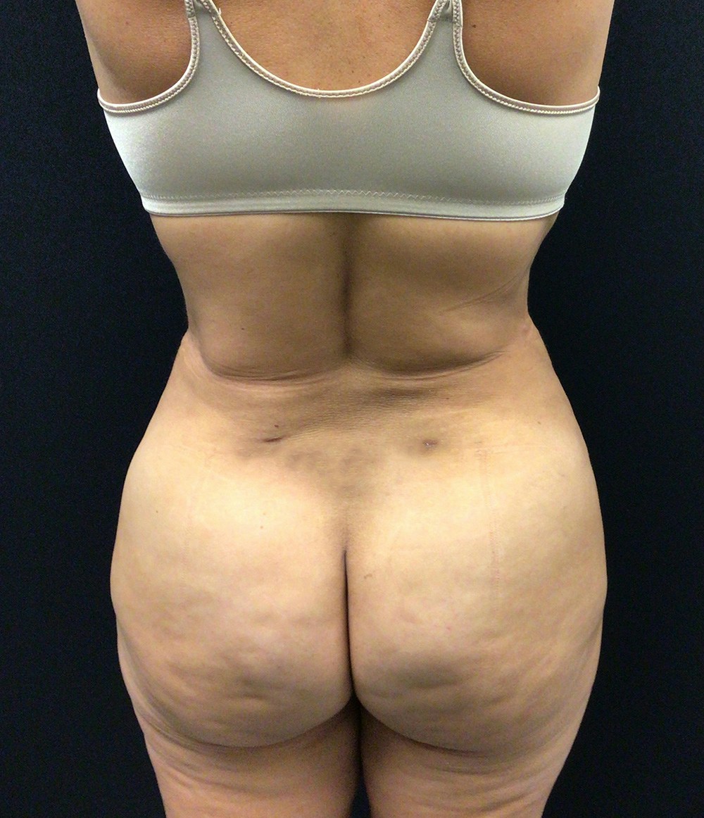 Brazilian Butt Lift Before & After Gallery - Patient 102617008 - Image 2