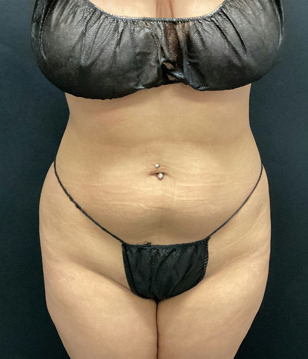 Brazilian Butt Lift Before & After Gallery - Patient 102617007 - Image 3