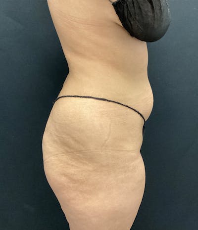 Brazilian Butt Lift Before & After Gallery - Patient 102617007 - Image 5