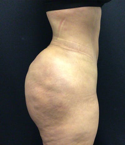 Brazilian Butt Lift Before & After Gallery - Patient 102617007 - Image 6