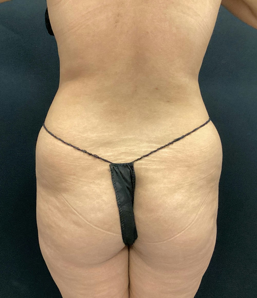 Brazilian Butt Lift Before & After Gallery - Patient 102617007 - Image 5