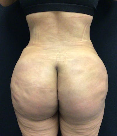 Brazilian Butt Lift Before & After Gallery - Patient 102617007 - Image 2