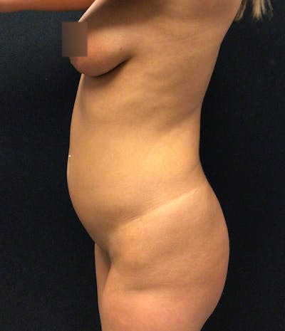 Brazilian Butt Lift Before & After Gallery - Patient 58243793 - Image 7