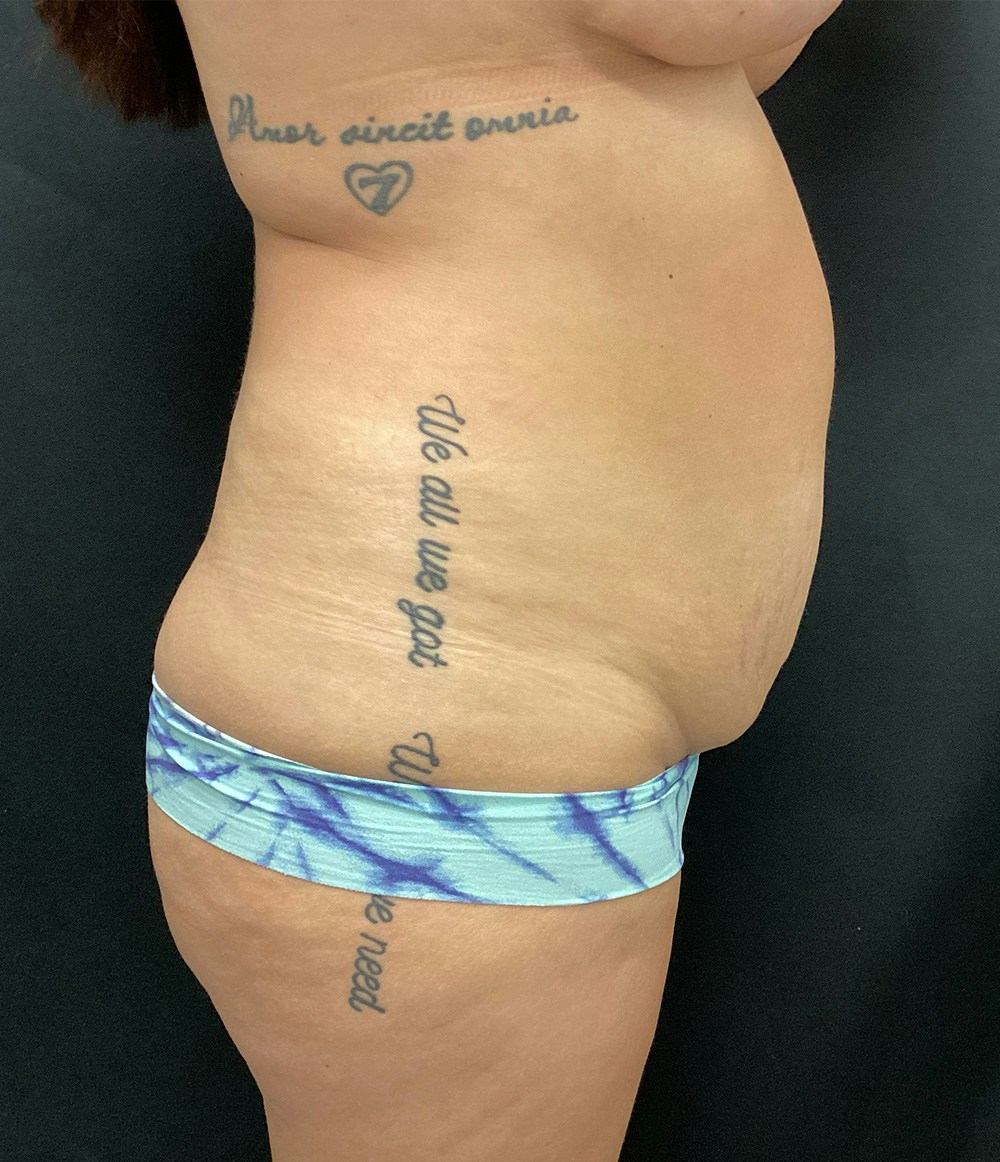 Brazilian Butt Lift Before & After Gallery - Patient 58243743 - Image 3