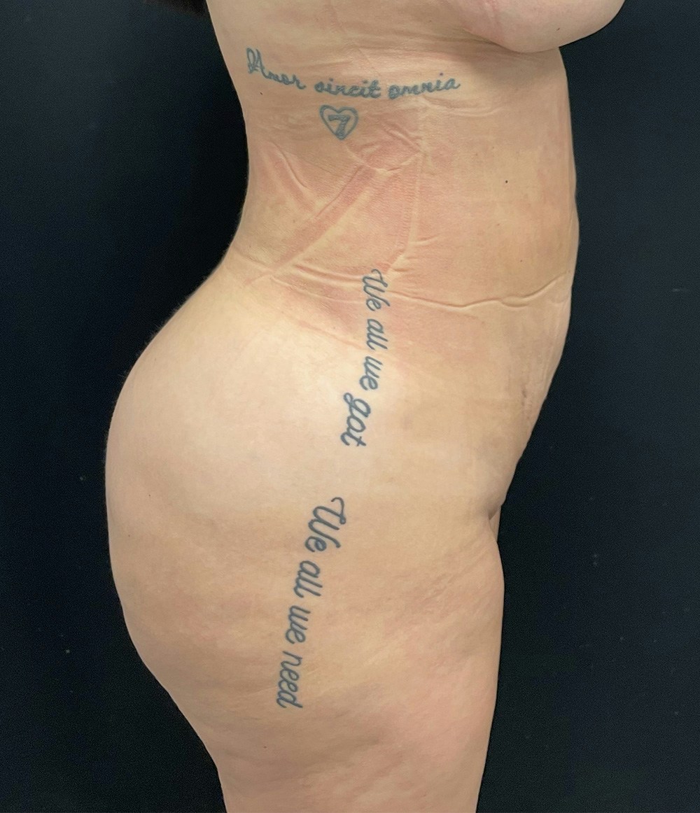 Brazilian Butt Lift Before & After Gallery - Patient 58243743 - Image 4