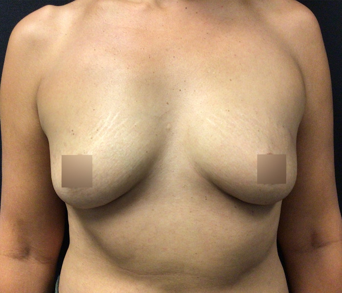 Breast Augmentation Before & After Gallery - Patient 102617291 - Image 1