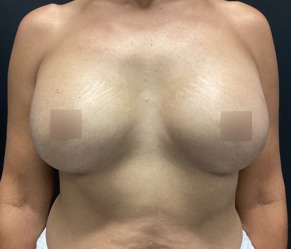 Breast Augmentation Before & After Gallery - Patient 102617291 - Image 2