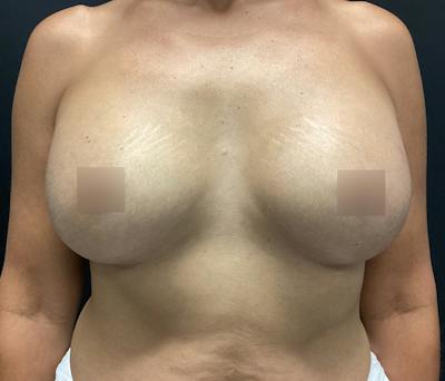 Breast Augmentation Before & After Gallery - Patient 102617291 - Image 2