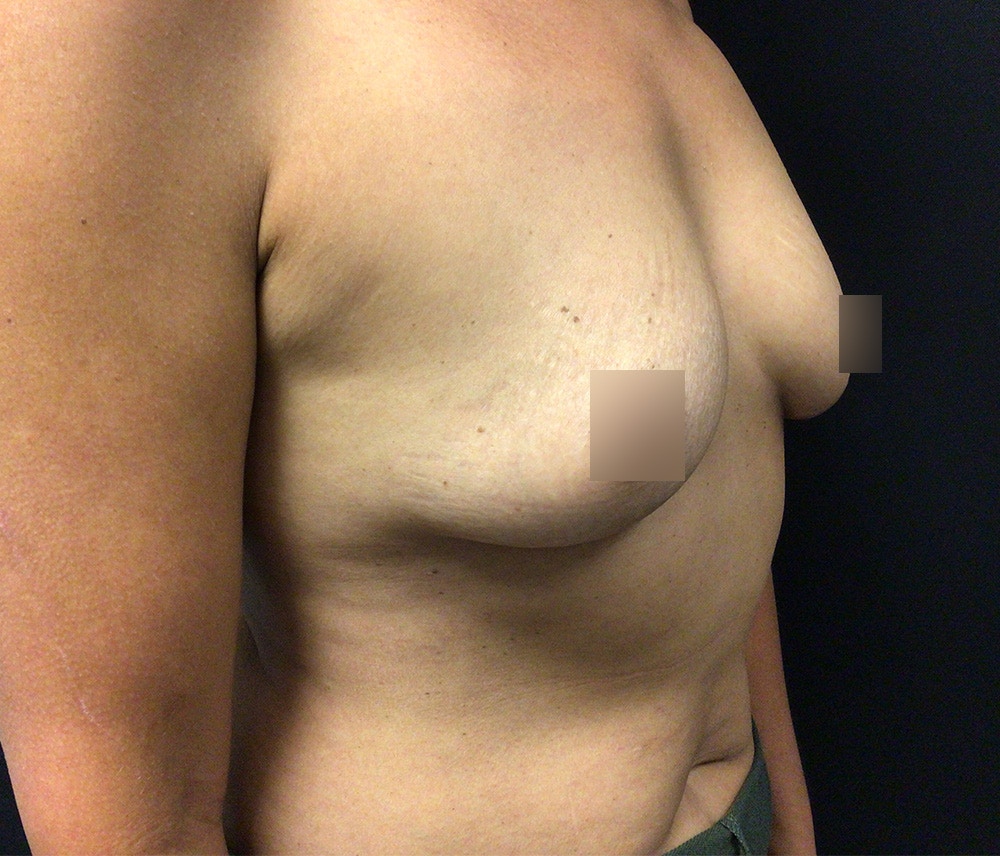 Breast Augmentation Before & After Gallery - Patient 102617291 - Image 3