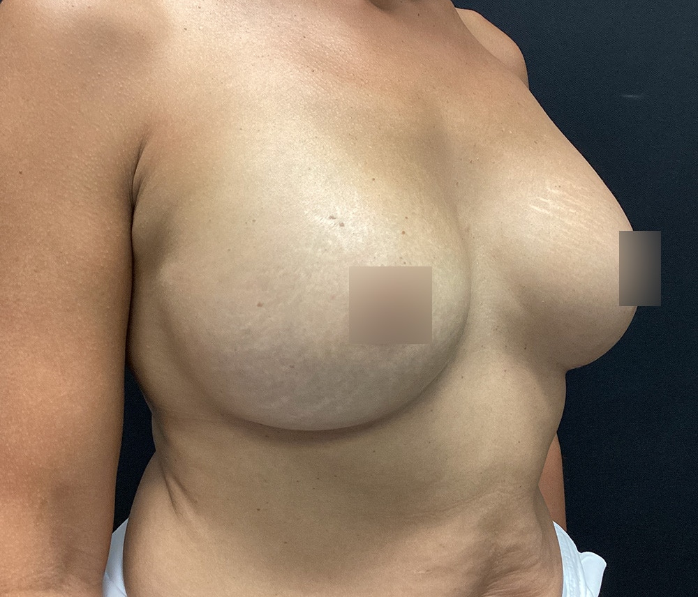 Breast Augmentation Before & After Gallery - Patient 102617291 - Image 4