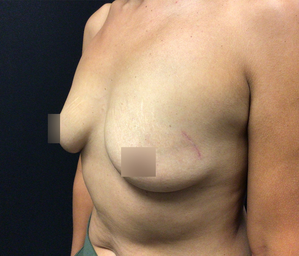 Breast Augmentation Before & After Gallery - Patient 102617291 - Image 5