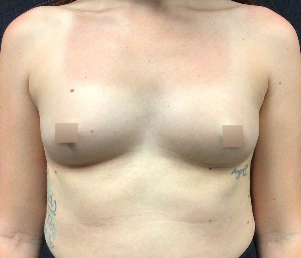 Breast Augmentation Before & After Gallery - Patient 102617290 - Image 1