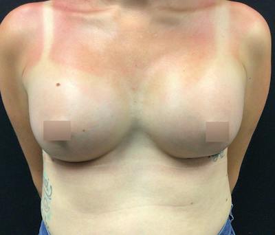 Breast Augmentation Before & After Gallery - Patient 102617290 - Image 2
